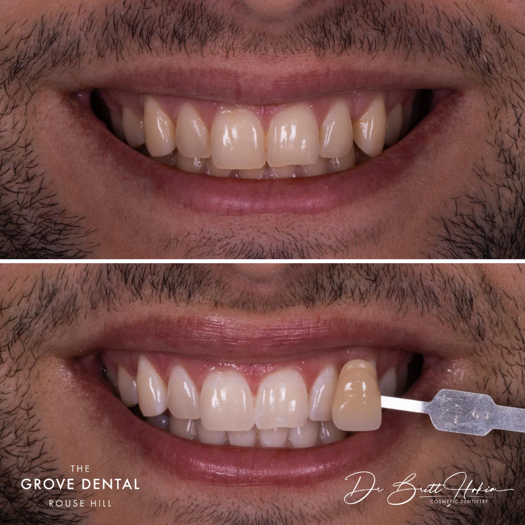 teeth-whitening-rouse-hill