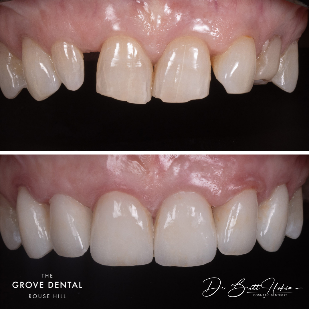 smile-makeover-veneers-rouse-hill