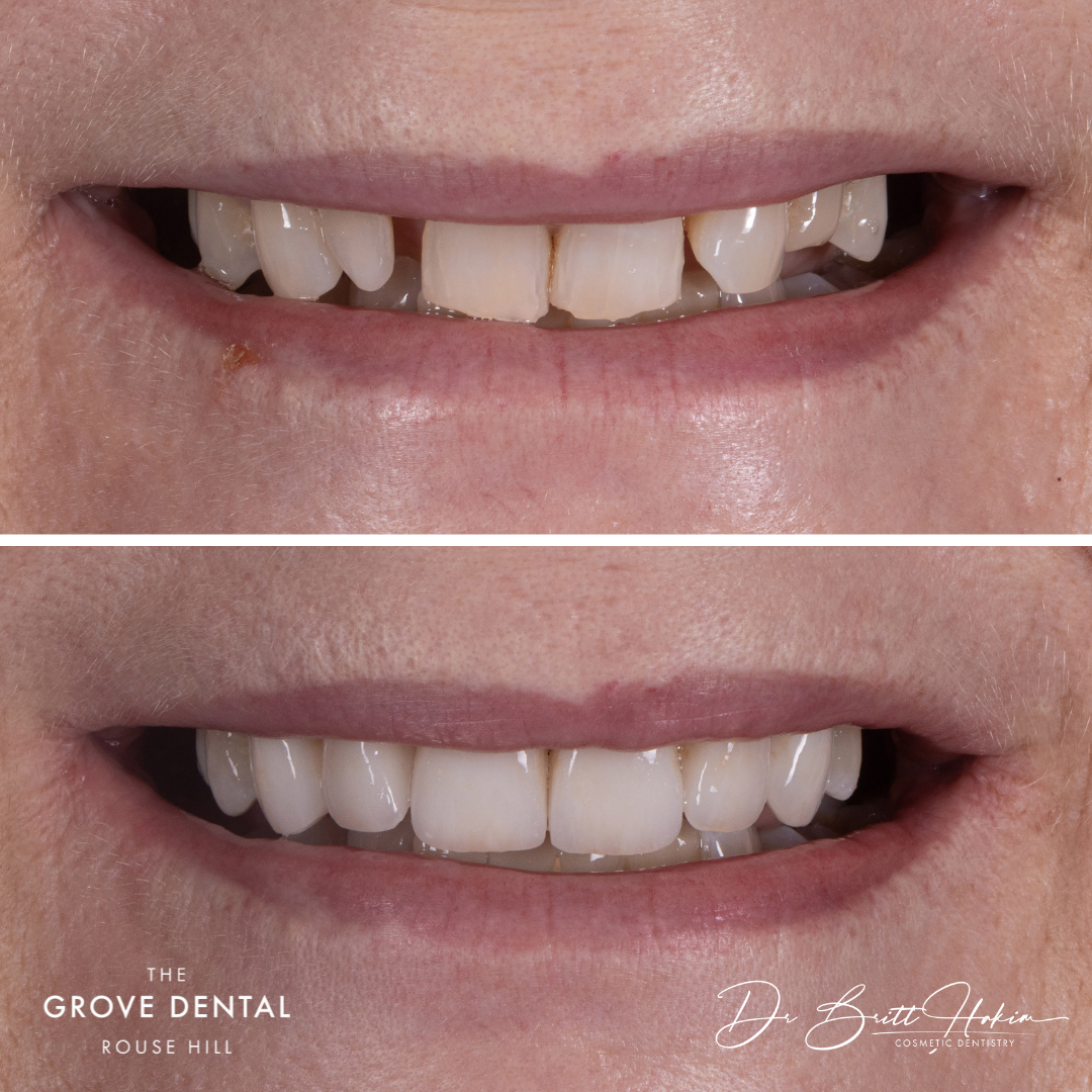 smile-makeover-veneers-rouse-hill
