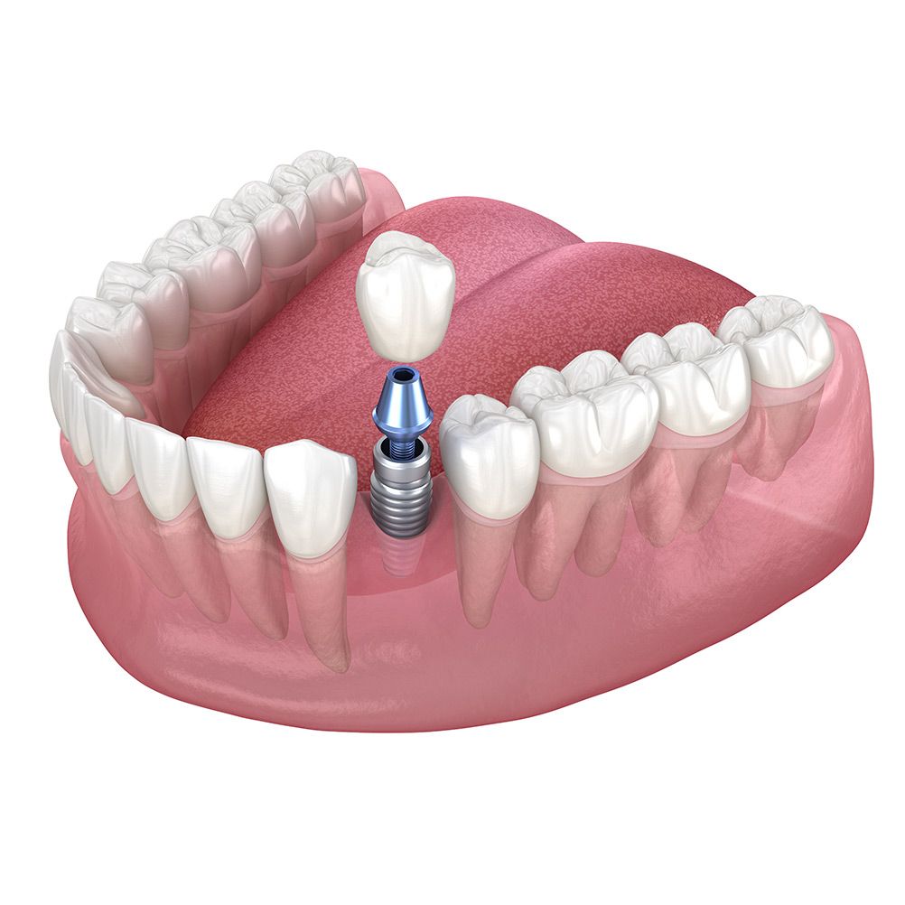 Single Tooth Dental Implants Rouse Hill