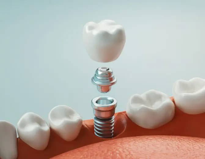 dental-implant-rouse-hill
