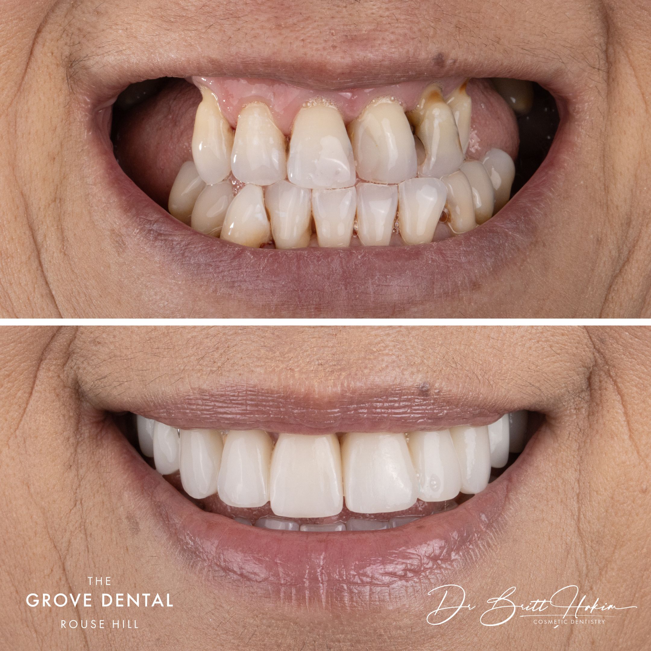 smile-makeover-rouse-hill-crowns-denture2