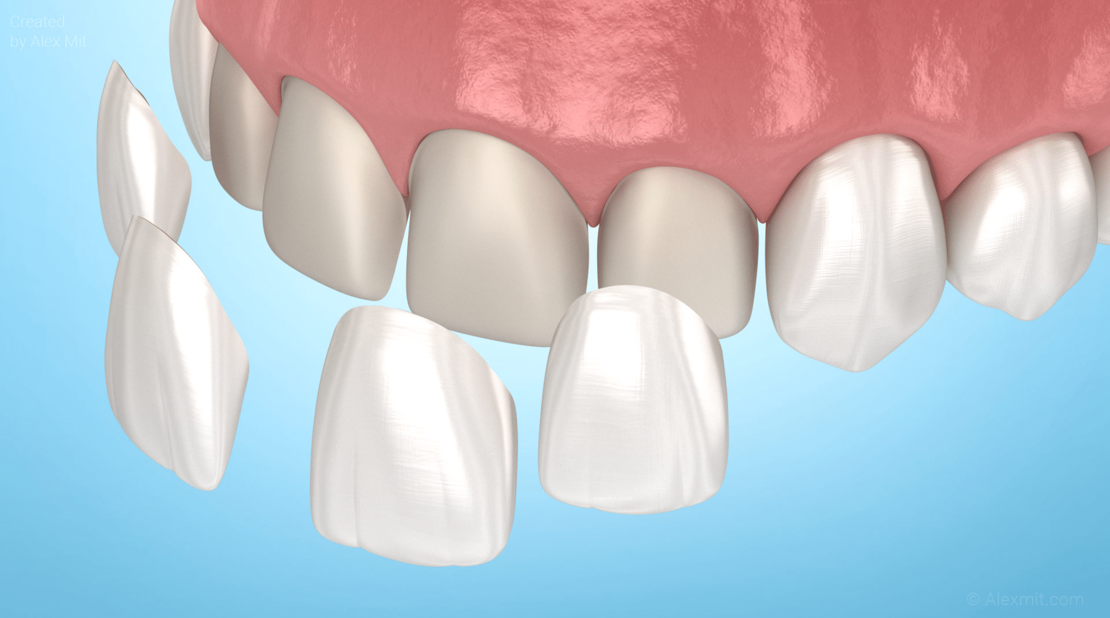 dental veneers rouse hill