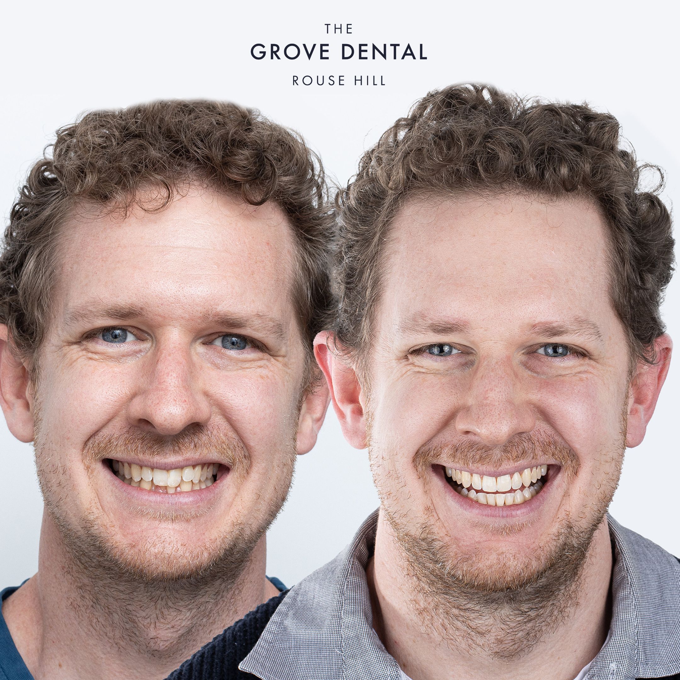 clear braces rouse hill transformation