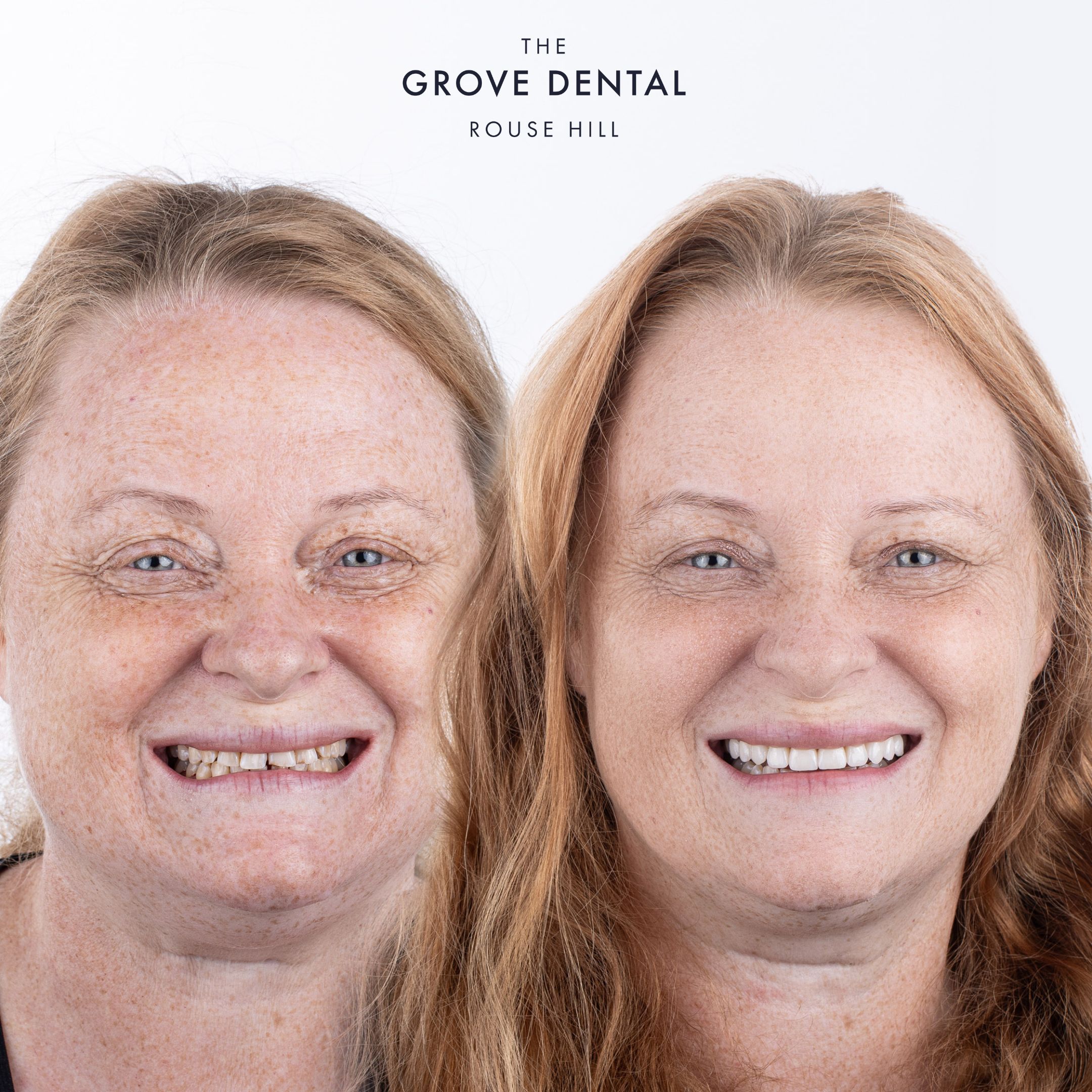 porcelain veneers rouse hill mummy makeover