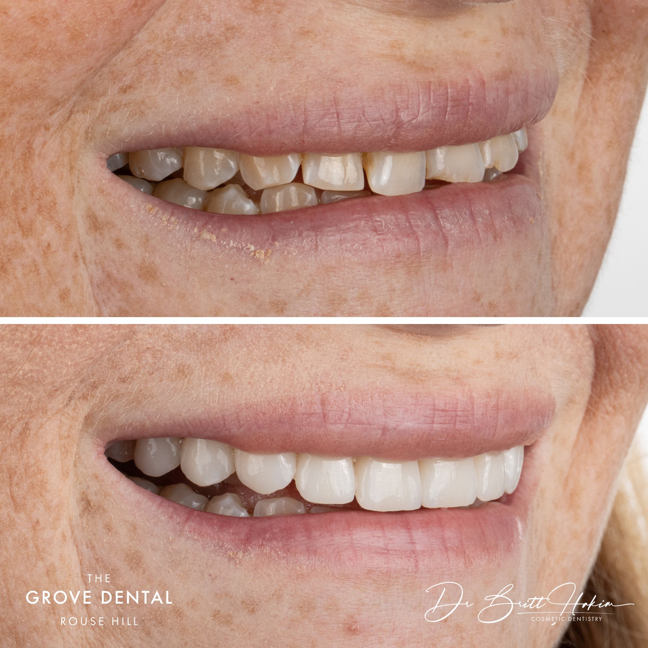 box hill porcelain smile transformation