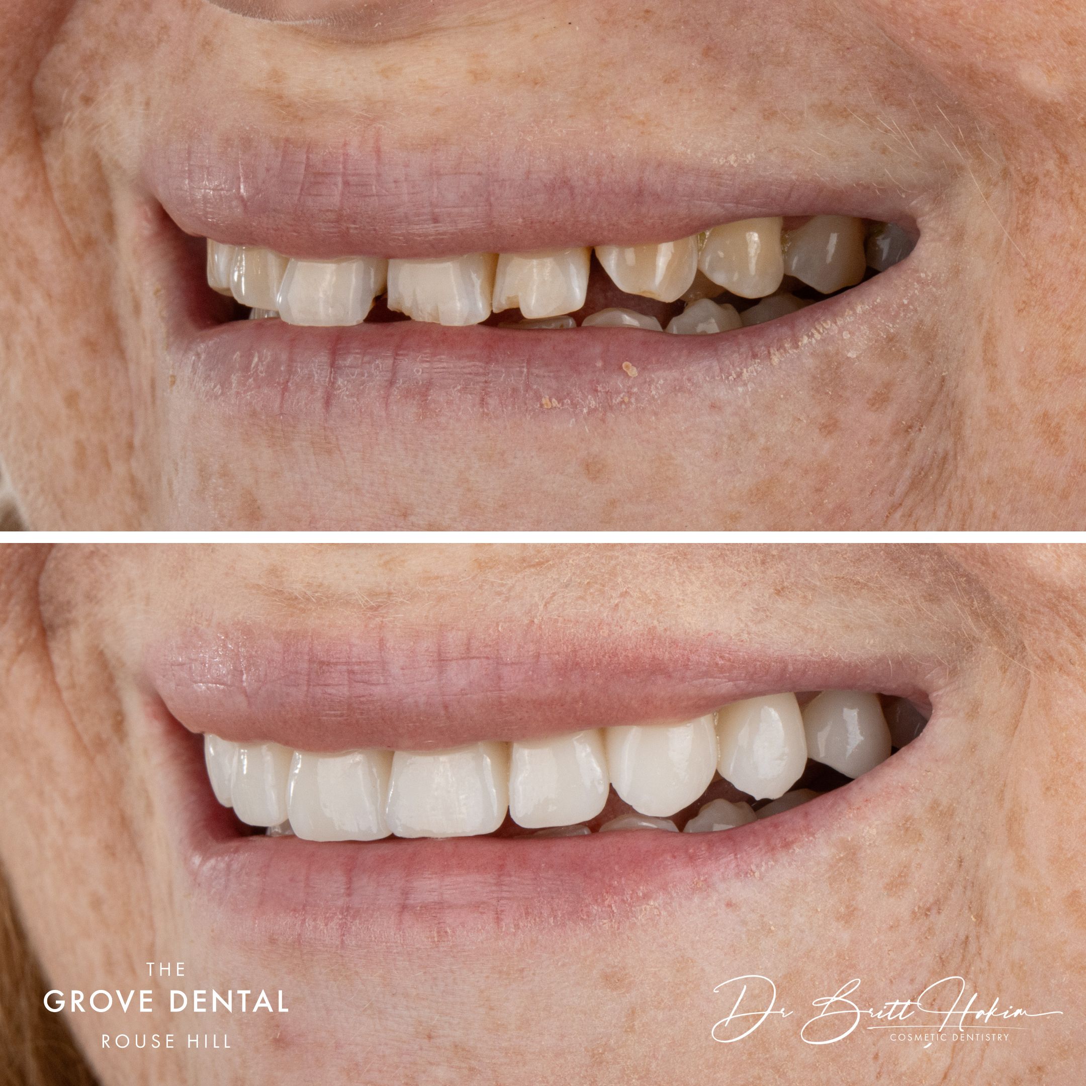 porcelain veneers smile makeover box hill nsw