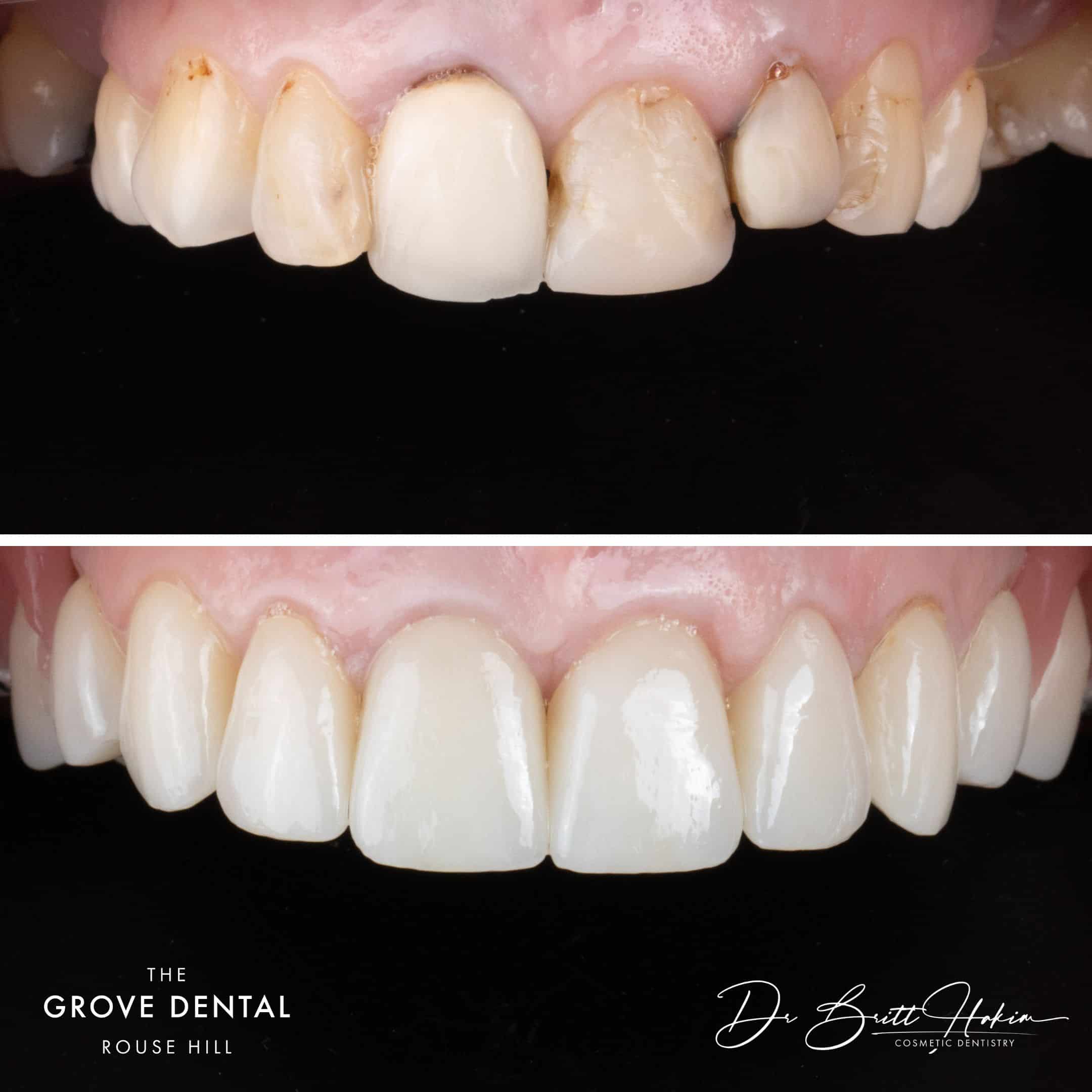 smile makeover north kellyville porcelain crowns