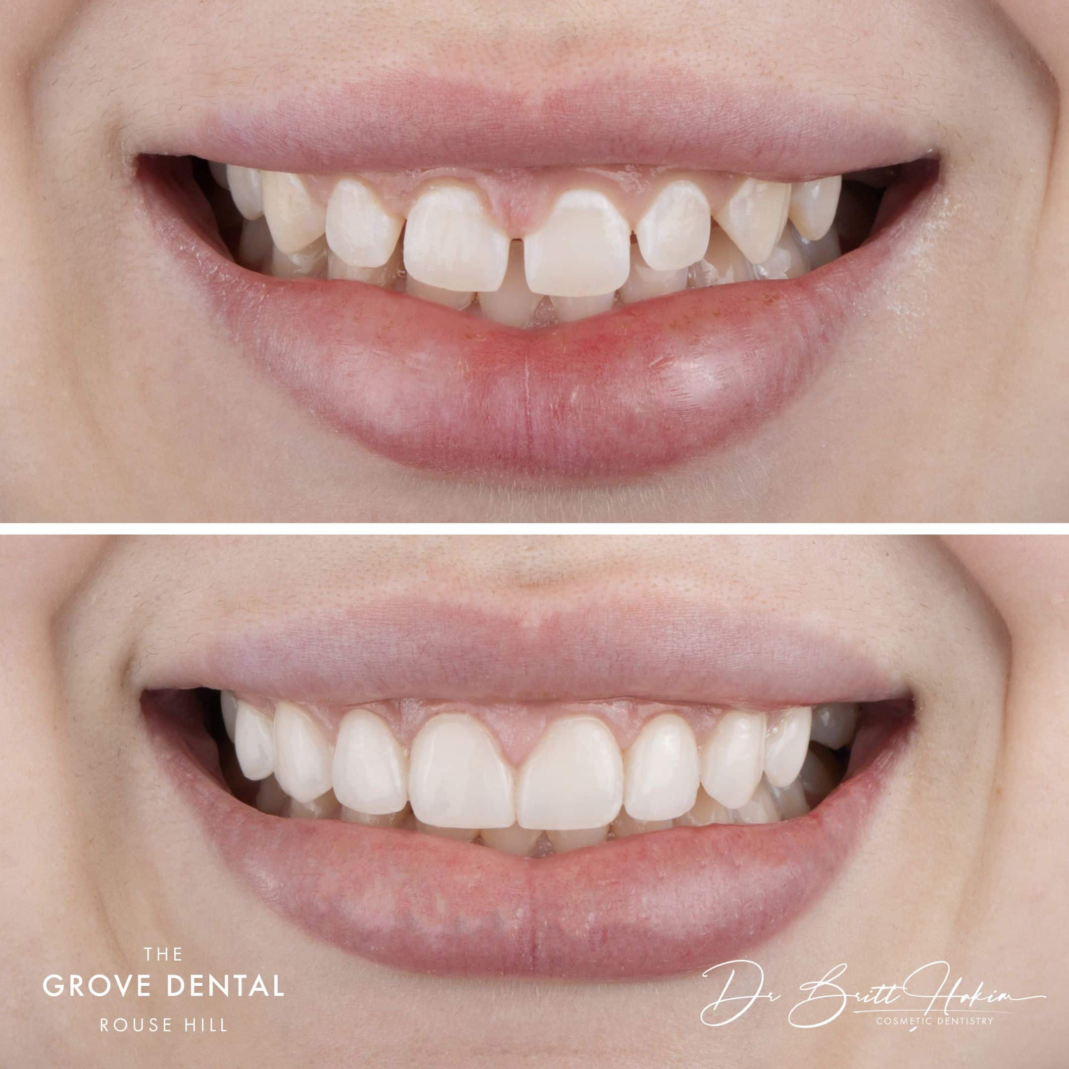 veneers porcelain sydney