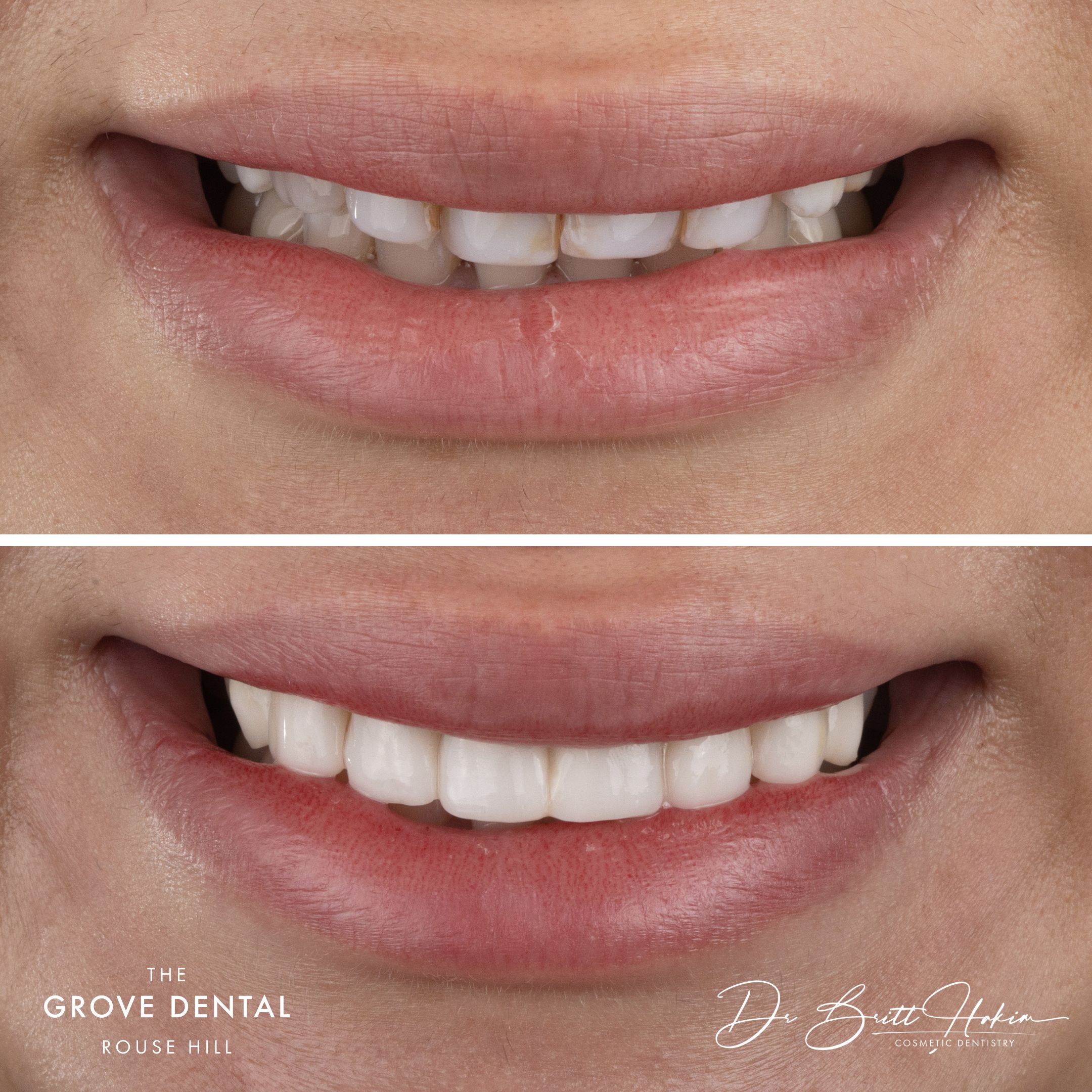 sydney composite veneers