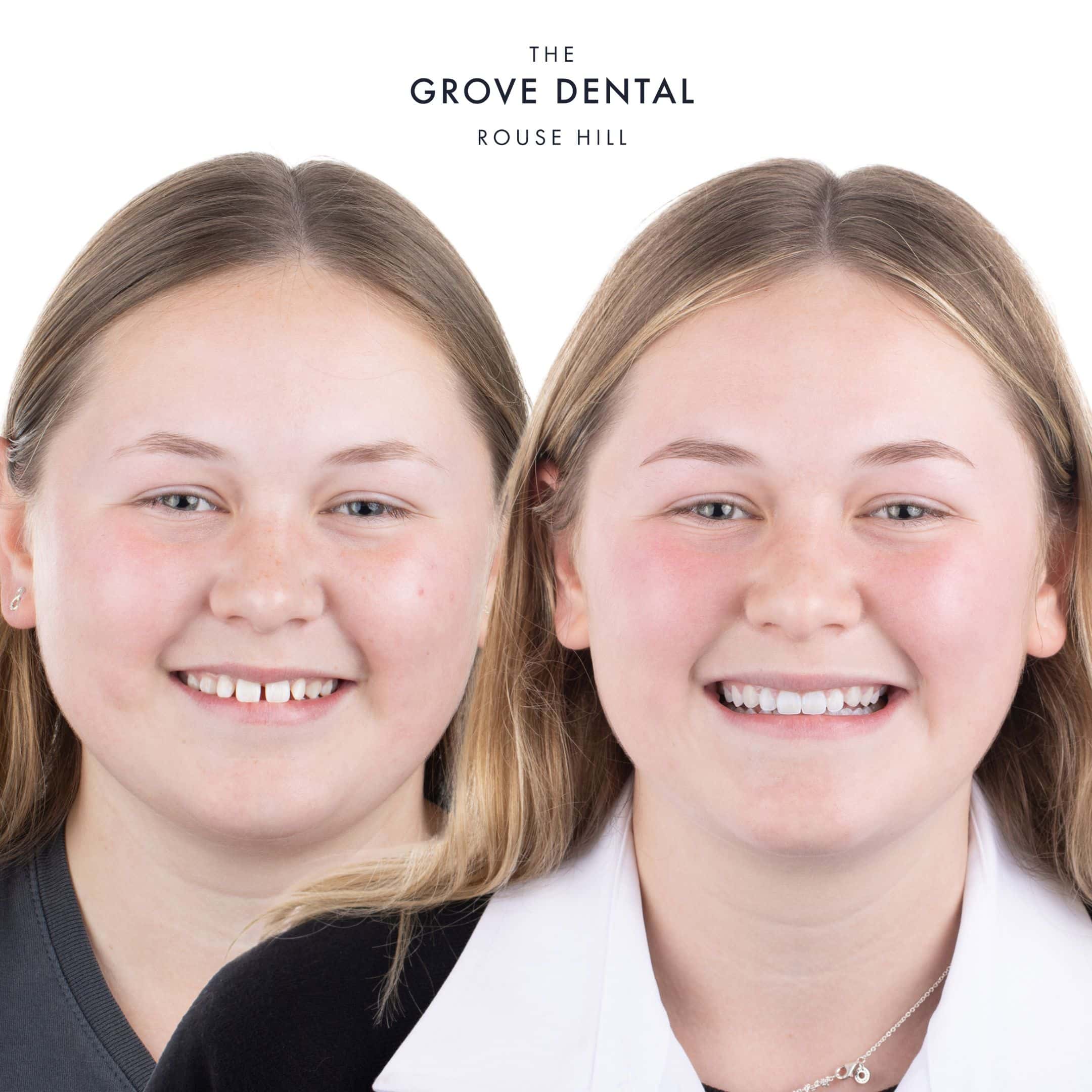 braces orthodontics rouse hill