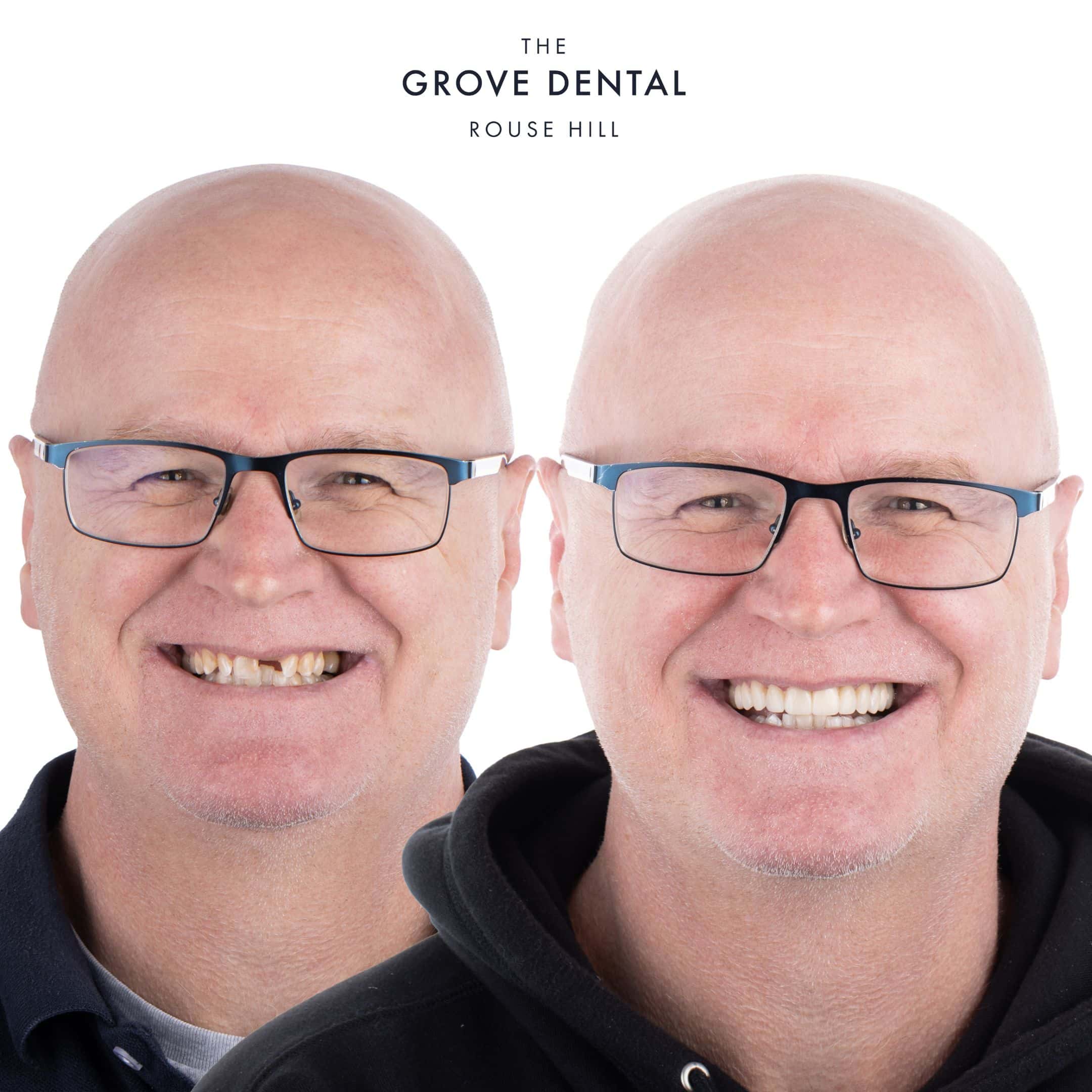 rouse hill smile makeover