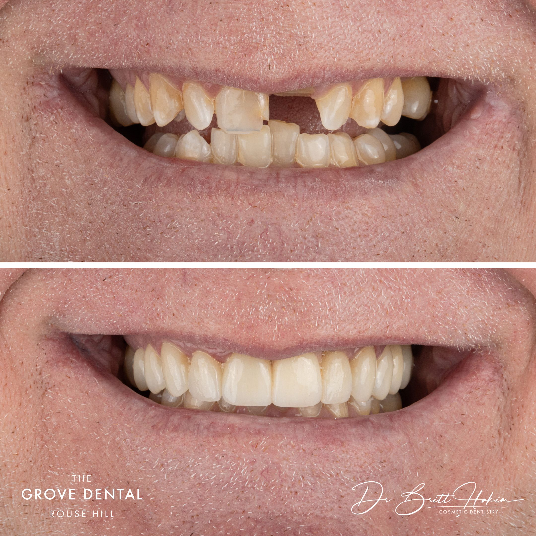 rouse hill smile makeover