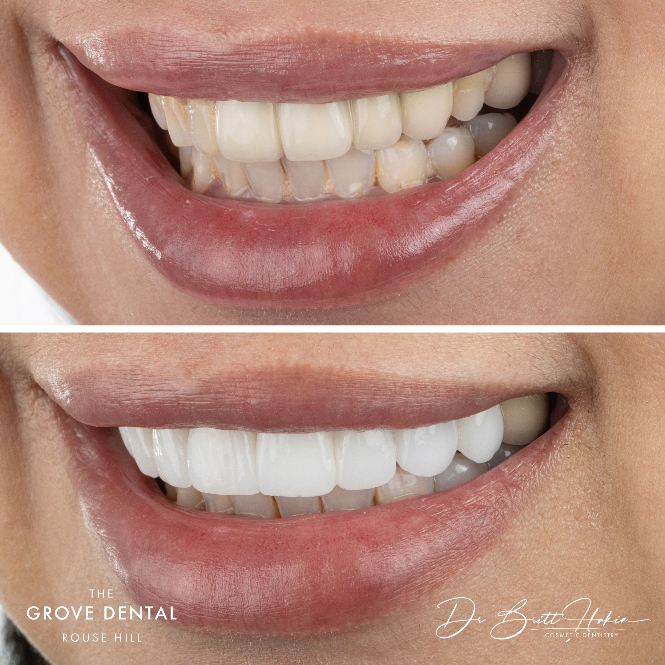 white porcelain veneers sydney