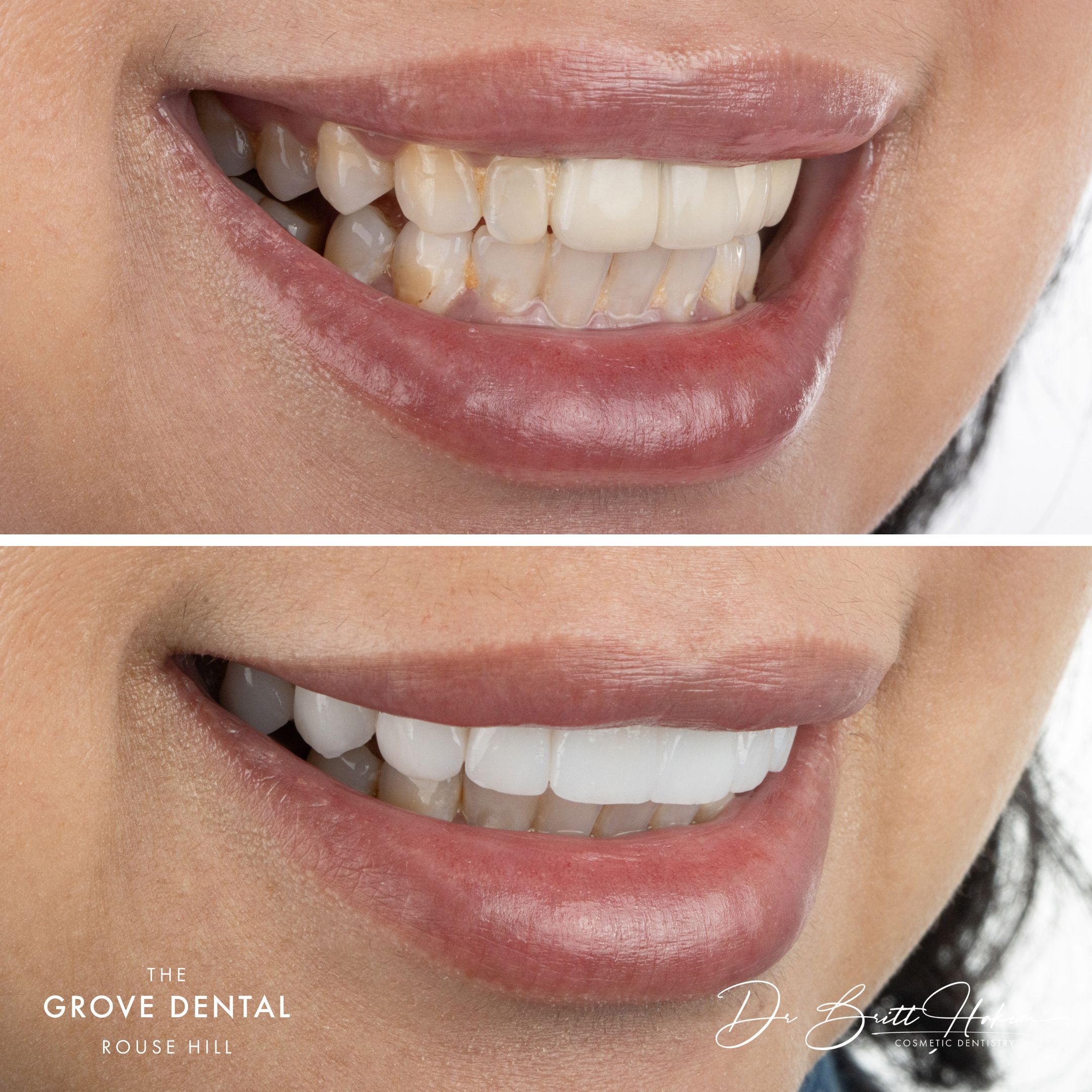 brightest white porcelain veneers sydney