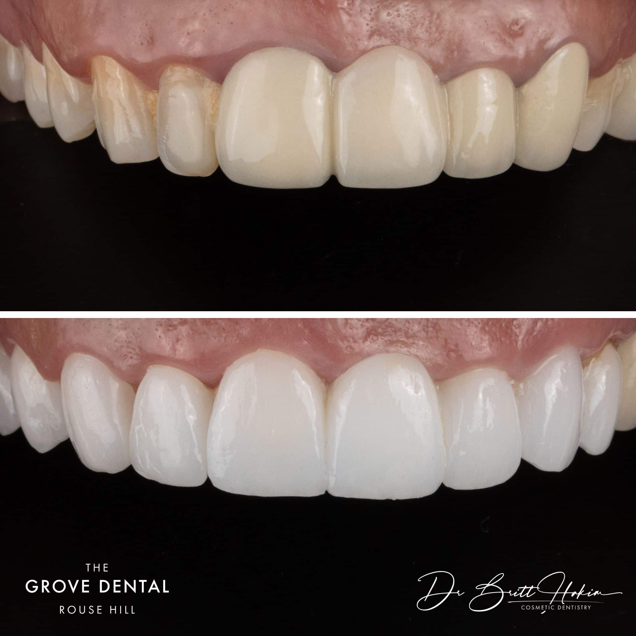 white porcelain veneers rouse hill